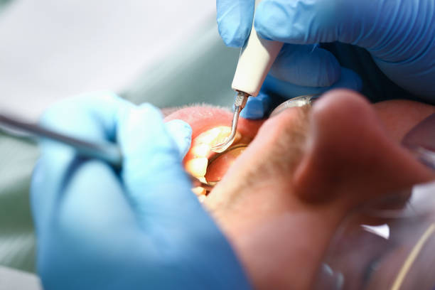Best Broken or Chipped Tooth Repair in St Helen, MI